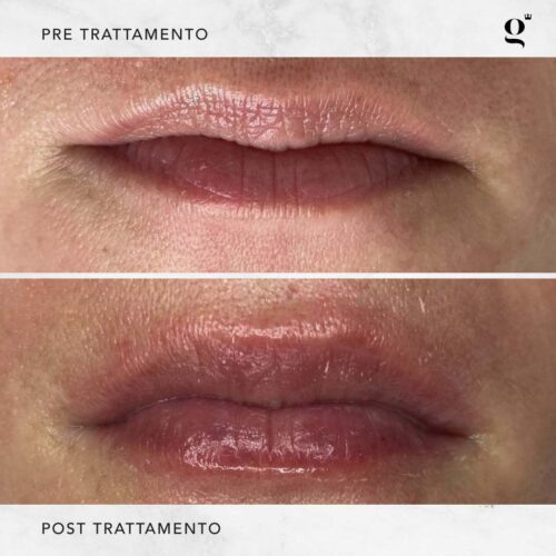 trattamenti-botox-labbra-naturali