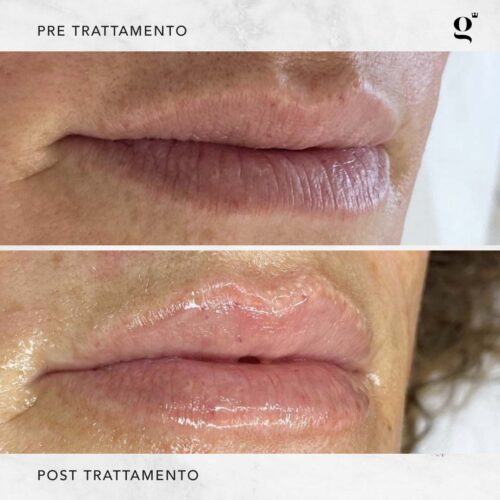 trattamenti-naturali-botox-labbra