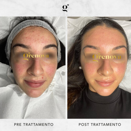 trattamento acne