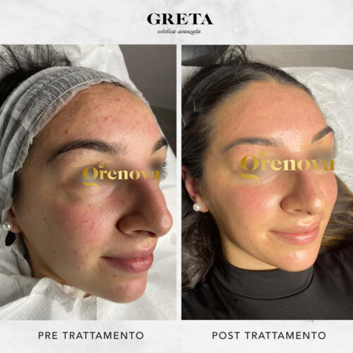 prodotti per trattare acne