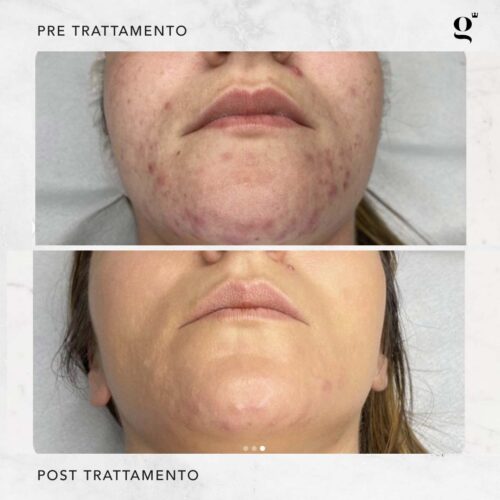 trattamenti-needling-acne