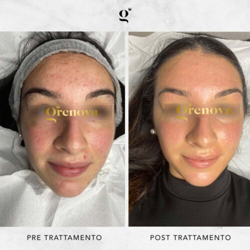 trattamenti-needling-contro-acne