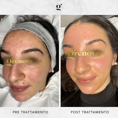 trattamenti-needling-domiciliari-acne