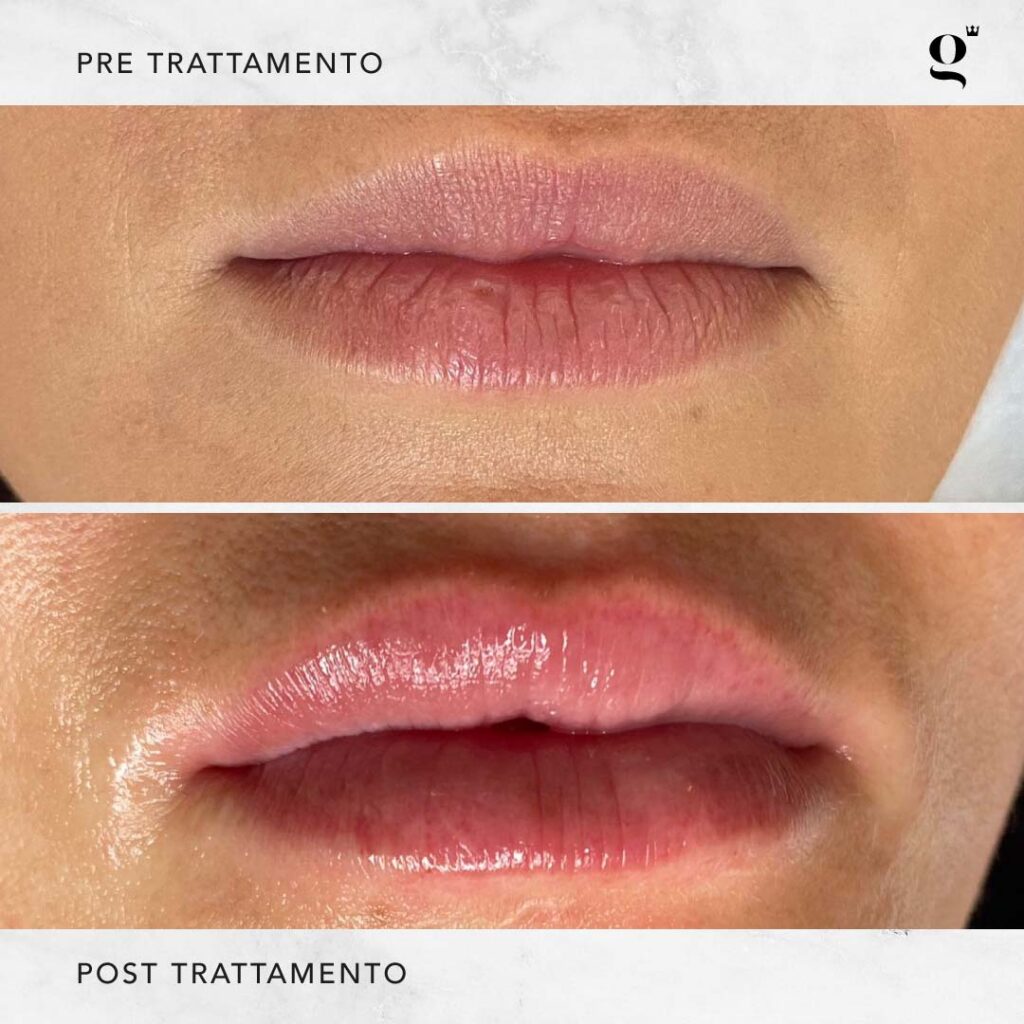 trattamenti-needling-domiciliari-botox-labbra