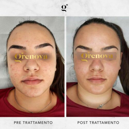 trattamenti-needling-domiciliari-contro-acne