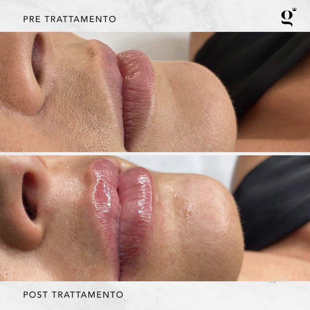 trattamenti-needling-domiciliari-labbra