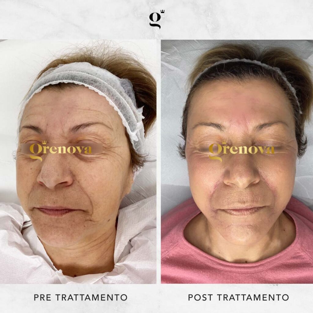 trattamenti-needling-domiciliari-per-rughe