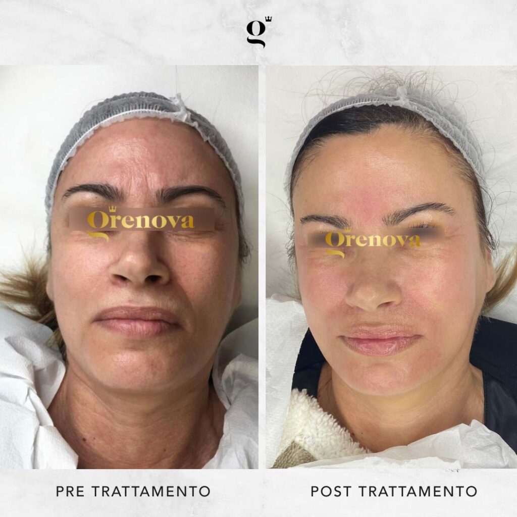 trattamenti-needling-domiciliari-rughe