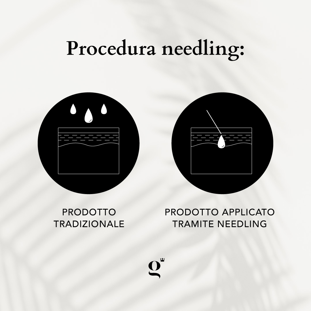 come-funziona-il-trattamento-needling