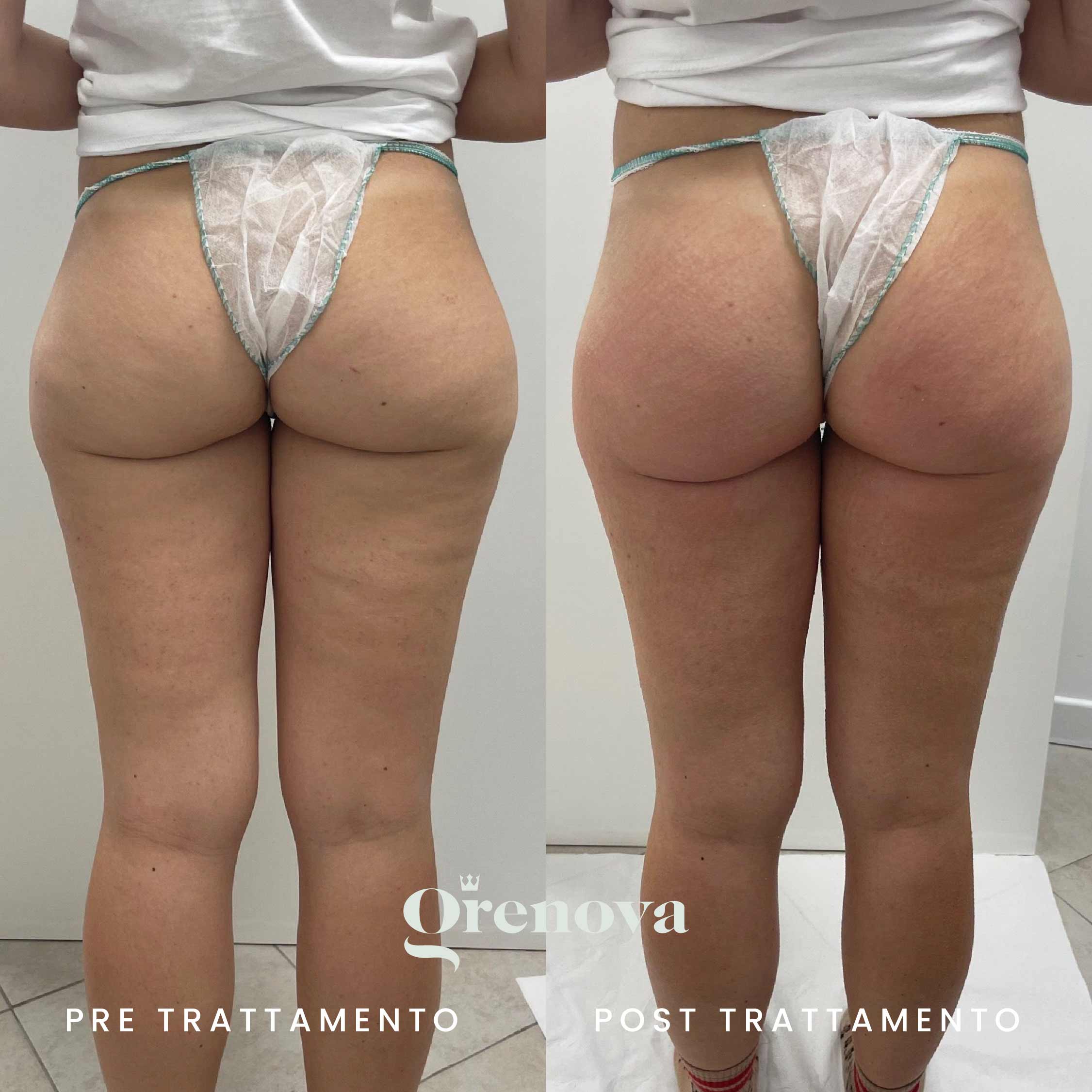 cellulite-microneedling