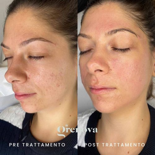 microneedling-cicatrici-post-acne