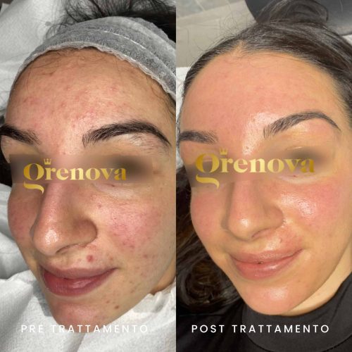 microneedling-grenova